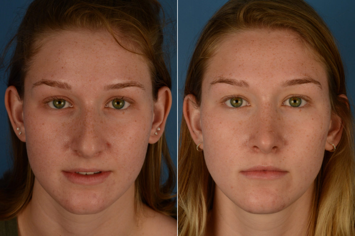 Rhinoplasty Before and After Photos in Naples, FL, Patient 18974