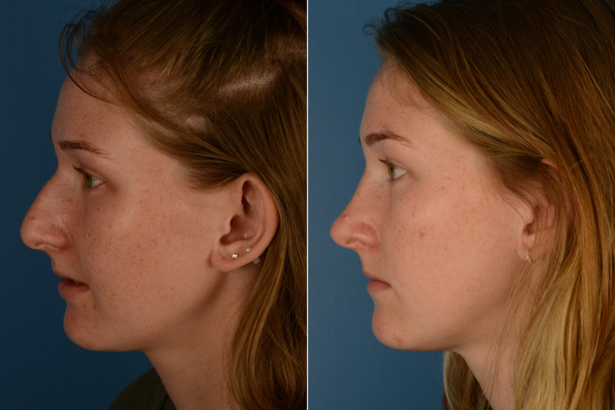 Rhinoplasty Before and After Photos in Naples, FL, Patient 18974