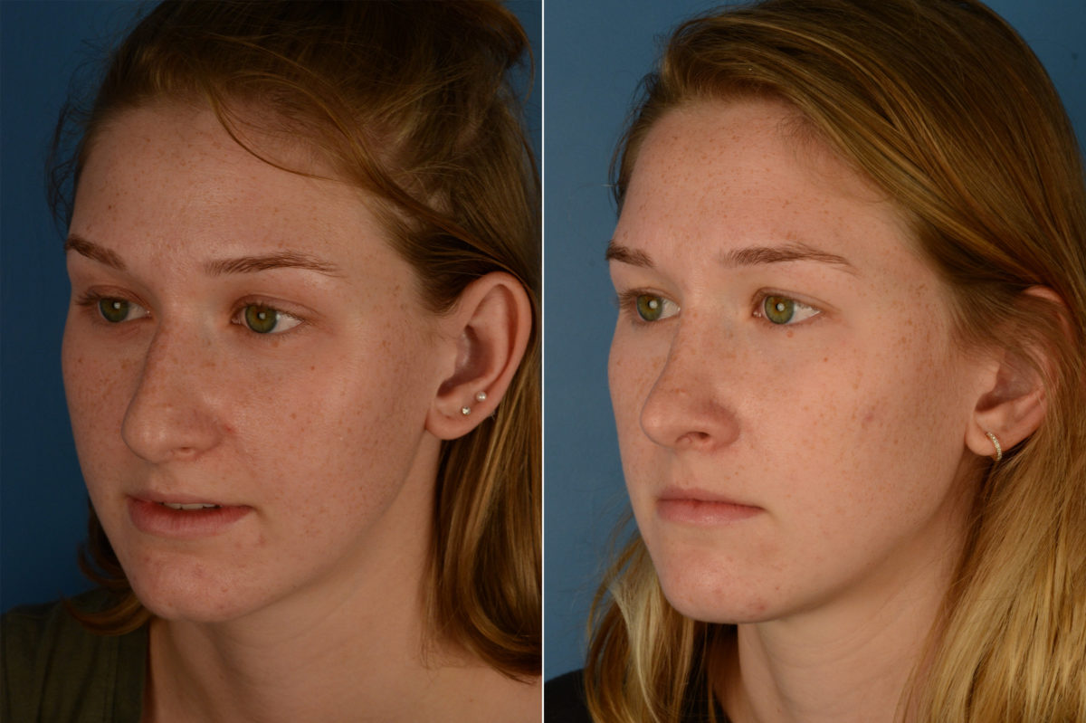 Rhinoplasty Before and After Photos in Naples, FL, Patient 18974