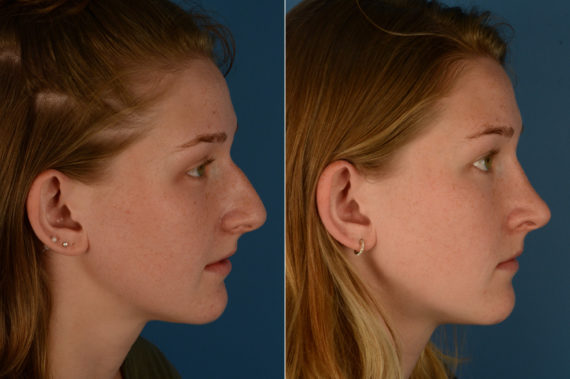 Rhinoplasty Before and After Photos in Naples, FL, Patient 18974
