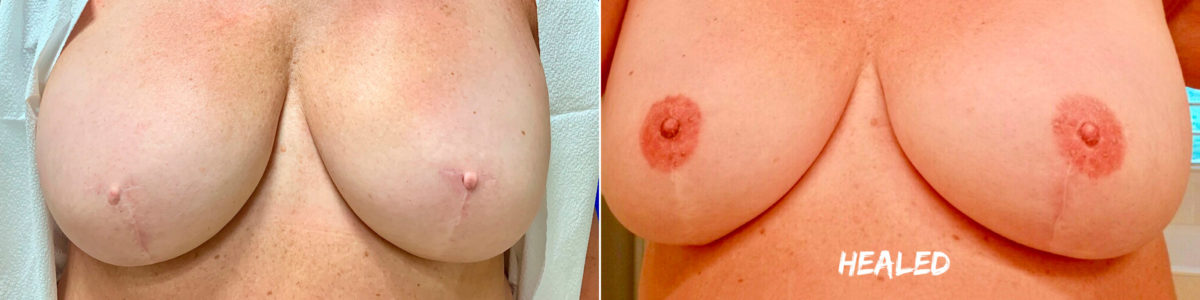 Permanent Makeup Before and After Photos in Naples, FL, Patient 19018