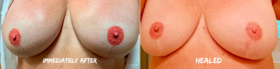 Permanent Makeup Before and After Photos in Naples, FL, Patient 19018
