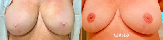 Permanent Makeup Before and After Photos in Naples, FL, Patient 19018
