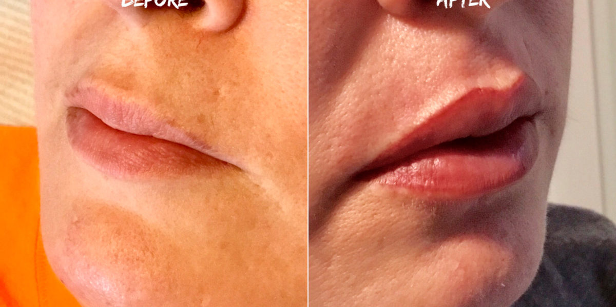 Permanent Makeup Before and After Photos in Naples, FL, Patient 19020