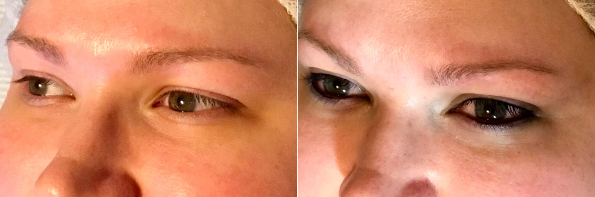 Permanent Makeup Before and After Photos in Naples, FL, Patient 19038