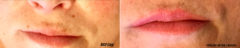 Permanent Makeup Before and After Photos in Naples, FL, Patient 19057