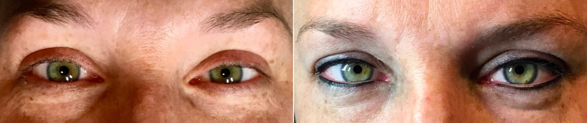 Permanent Makeup Before and After Photos in Naples, FL, Patient 19071