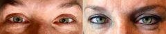 Permanent Makeup Before and After Photos in , , Patient 19071