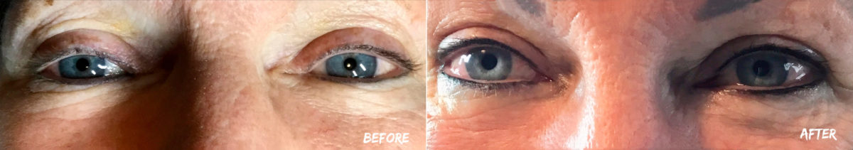 Permanent Makeup Before and After Photos in Naples, FL, Patient 19077