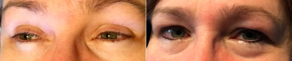 Permanent Makeup Before and After Photos in Naples, FL, Patient 19126