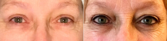 Permanent Makeup Before and After Photos in Naples, FL, Patient 19129