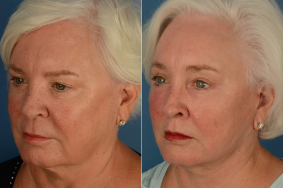 Eyebrow & Forehead Before and After Photos in Naples, FL, Patient 19147