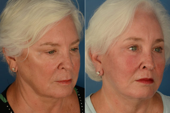 Eyebrow & Forehead Before and After Photos in Naples, FL, Patient 19147