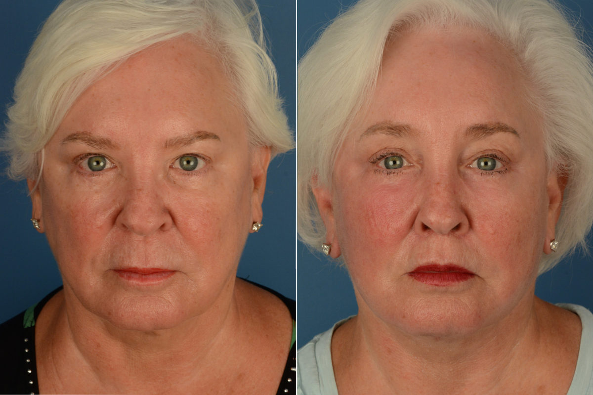 Eyebrow & Forehead Before and After Photos in Naples, FL, Patient 19147