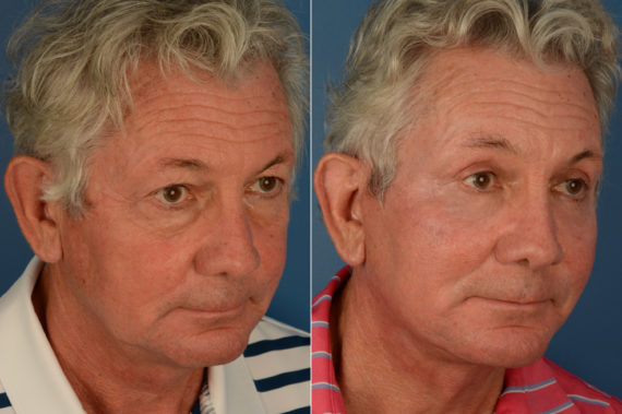 Blepharoplasty Before and After Photos in Naples, FL, Patient 19157