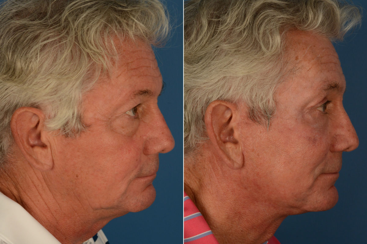 Blepharoplasty Before and After Photos in Naples, FL, Patient 19157