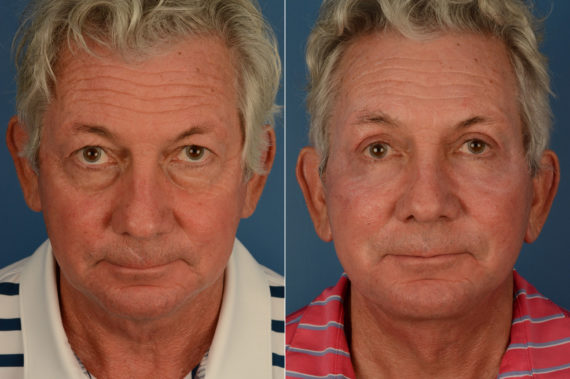 Blepharoplasty Before and After Photos in Naples, FL, Patient 19157