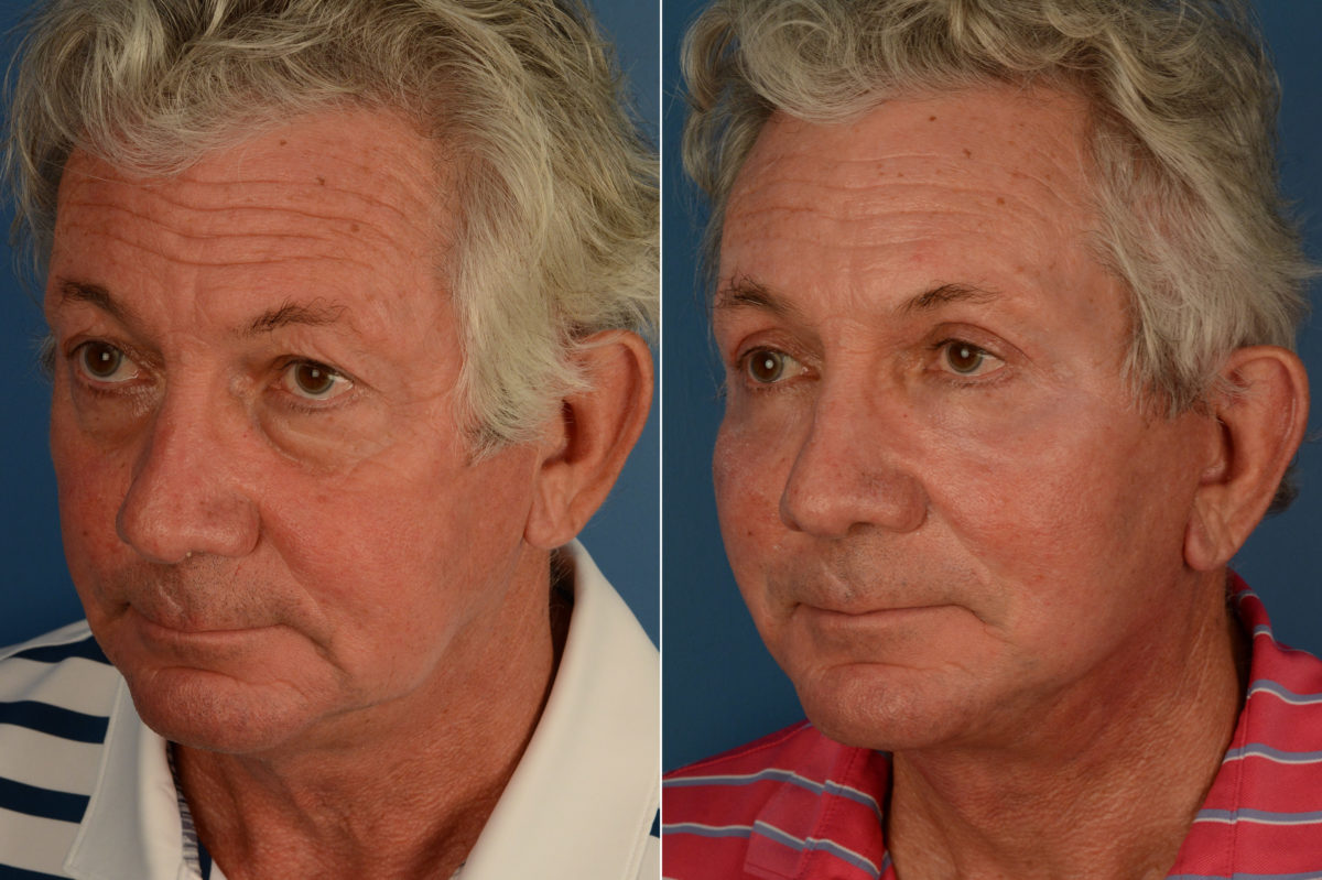 Blepharoplasty Before and After Photos in Naples, FL, Patient 19157