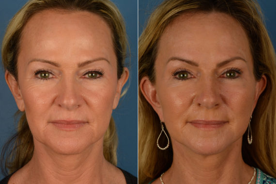 Blepharoplasty Before and After Photos in Naples, FL, Patient 19195