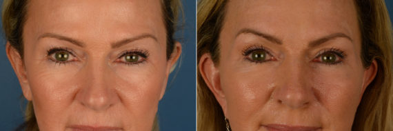 Blepharoplasty Before and After Photos in Naples, FL, Patient 19195