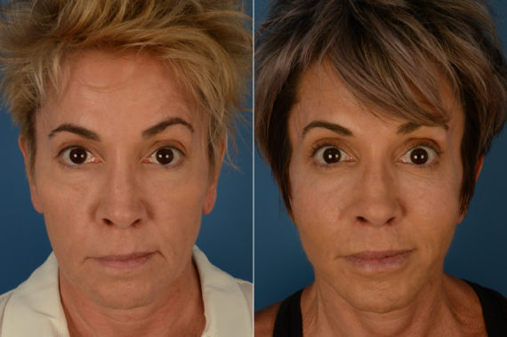 Cheek Implants Before and After Photos in Naples, FL, Patient 19202