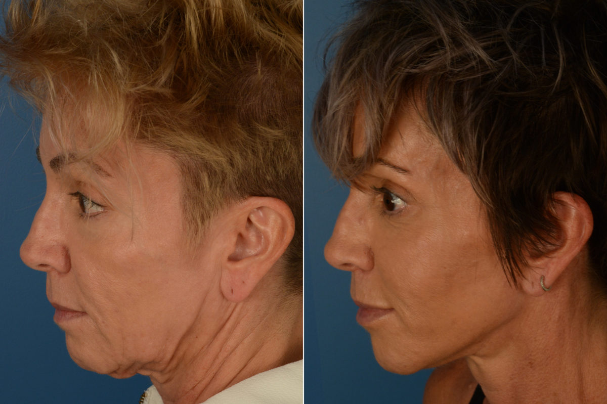 Cheek Implants Before and After Photos in Naples, FL, Patient 19202