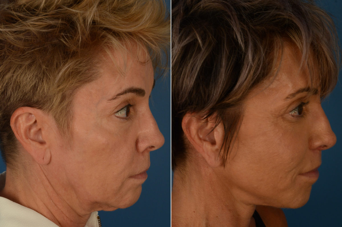 Cheek Implants Before and After Photos in Naples, FL, Patient 19202
