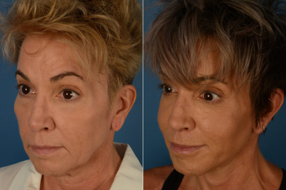 Cheek Implants Before and After Photos in Naples, FL, Patient 19202