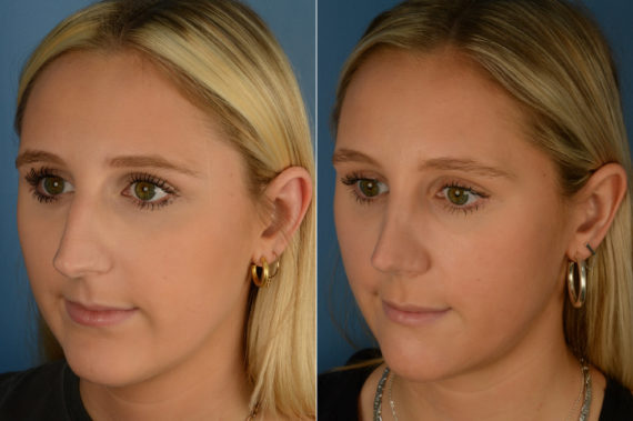 Rhinoplasty Before and After Photos in Naples, FL, Patient 19218