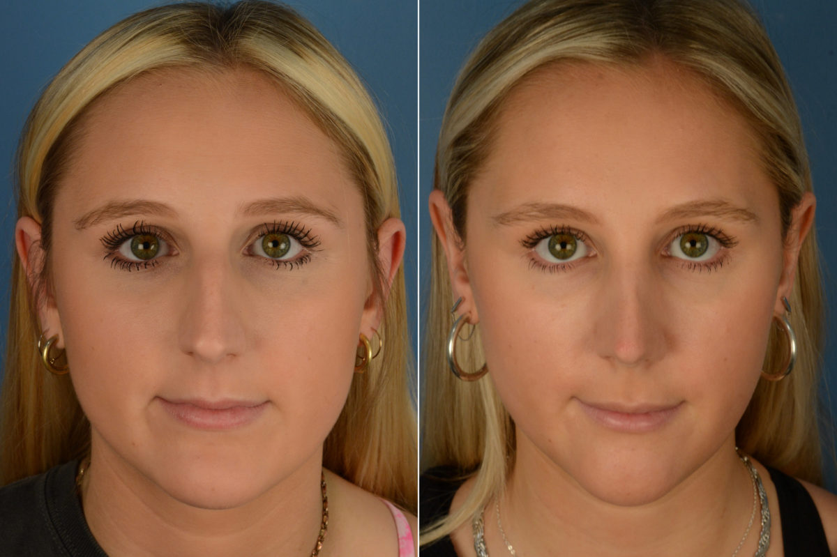 Rhinoplasty Before and After Photos in Naples, FL, Patient 19218