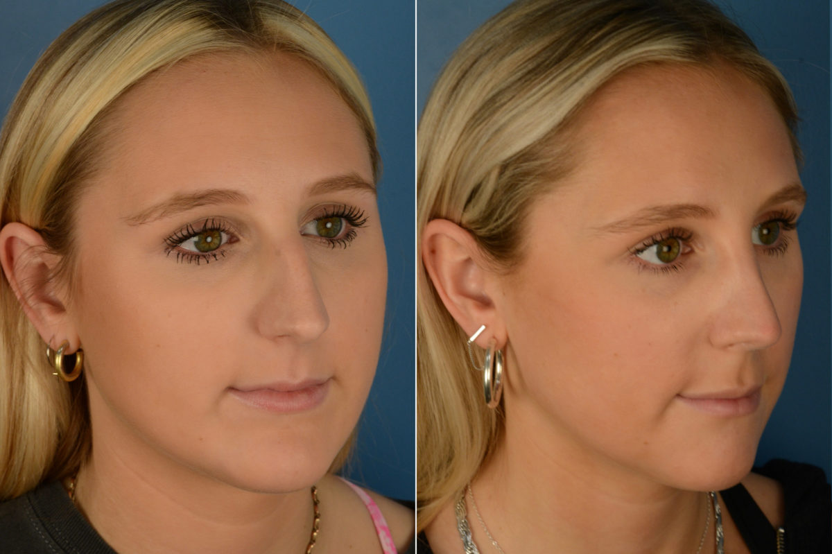Rhinoplasty Before and After Photos in Naples, FL, Patient 19218