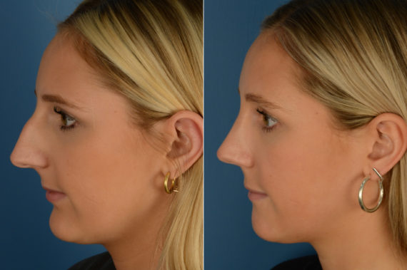 Rhinoplasty Before and After Photos in Naples, FL, Patient 19218