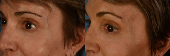 Cutera Excel V Laser Before and After Photos in Naples, FL, Patient 19219