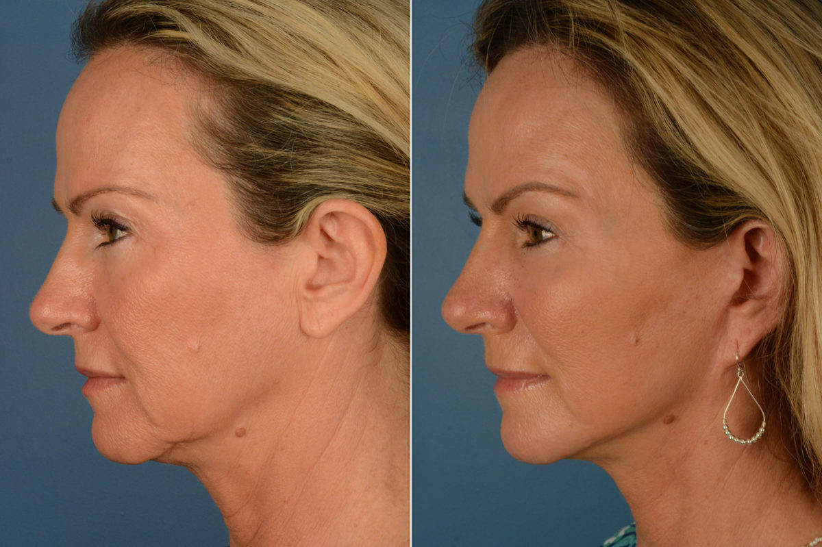 Endoscopic Facelift Before and After Photos in Naples, FL, Patient 19235