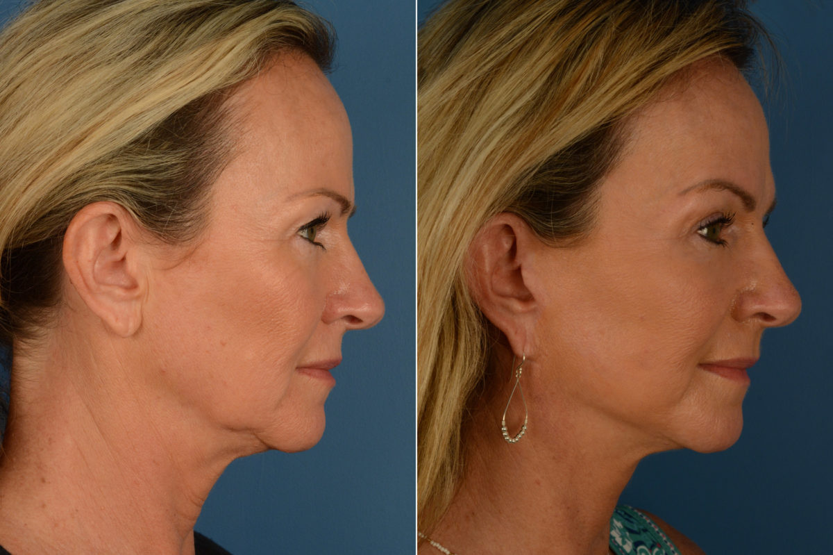 Endoscopic Facelift Before and After Photos in Naples, FL, Patient 19235