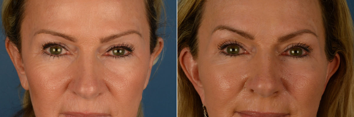 Endoscopic Facelift Before and After Photos in Naples, FL, Patient 19235