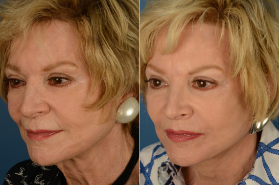 Lip Lift Before and After Photos in Naples, FL, Patient 19268