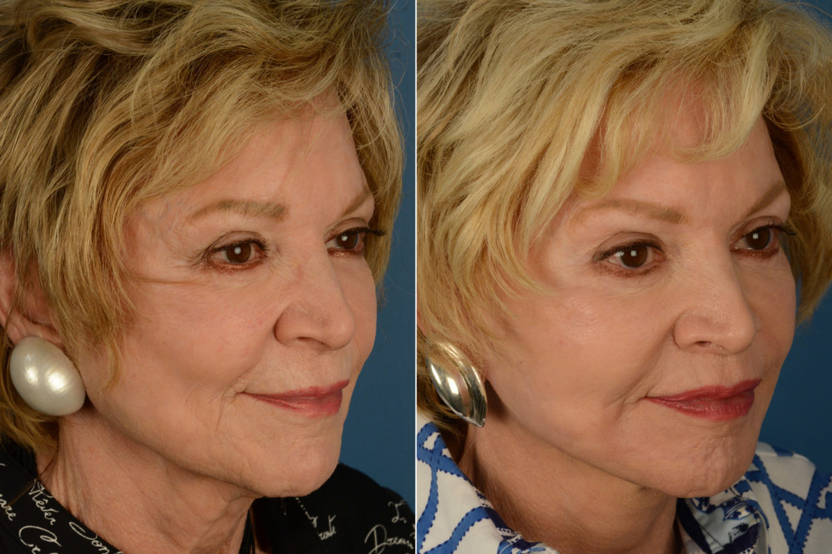Lip Lift Before and After Photos in Naples, FL, Patient 19268
