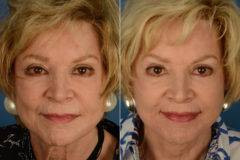 Lip Lift Before and After Photos in Naples, FL, Patient 19268