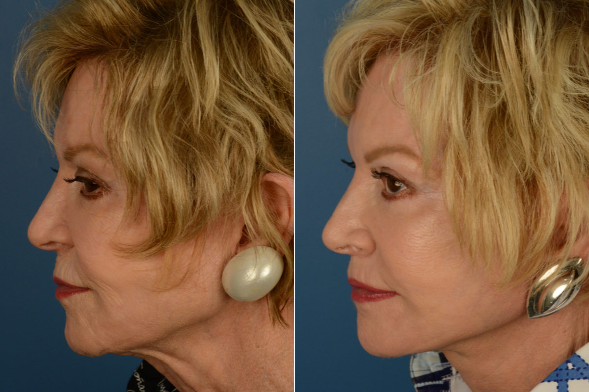 Lip Lift Before and After Photos in Naples, FL, Patient 19268