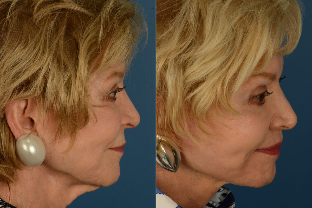 Lip Lift Before and After Photos in Naples, FL, Patient 19268