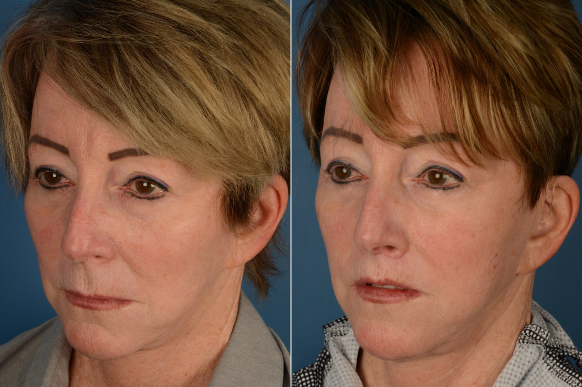 Lip Lift Before and After Photos in Naples, FL, Patient 19319