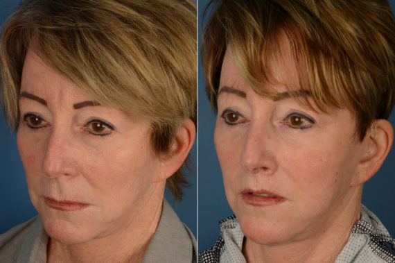 Lip Lift Before and After Photos in Naples, FL, Patient 19319
