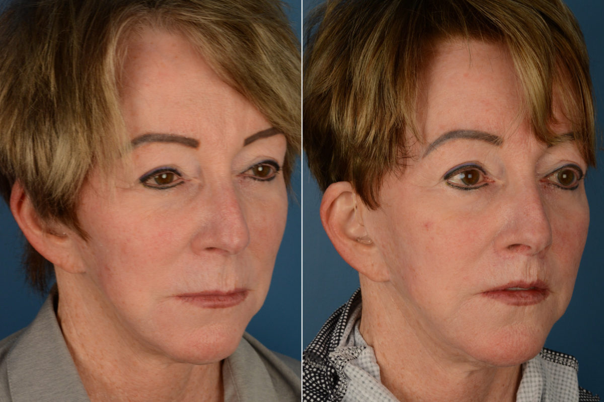 Lip Lift Before and After Photos in Naples, FL, Patient 19319