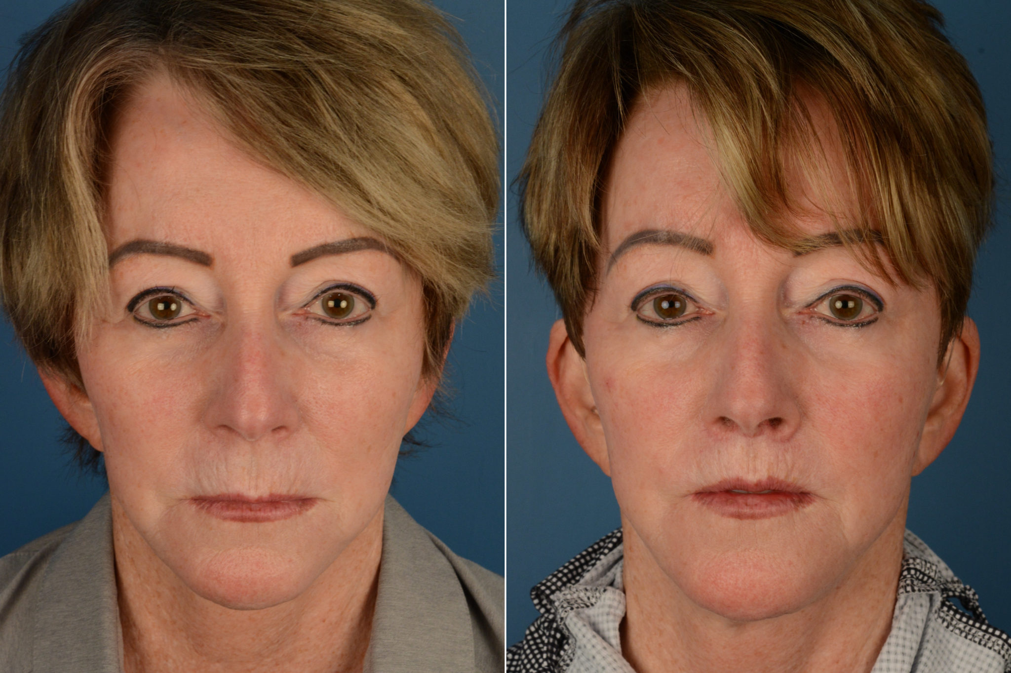 Lip Lift photos - Aesthetic Surgery Center | Naples, FL