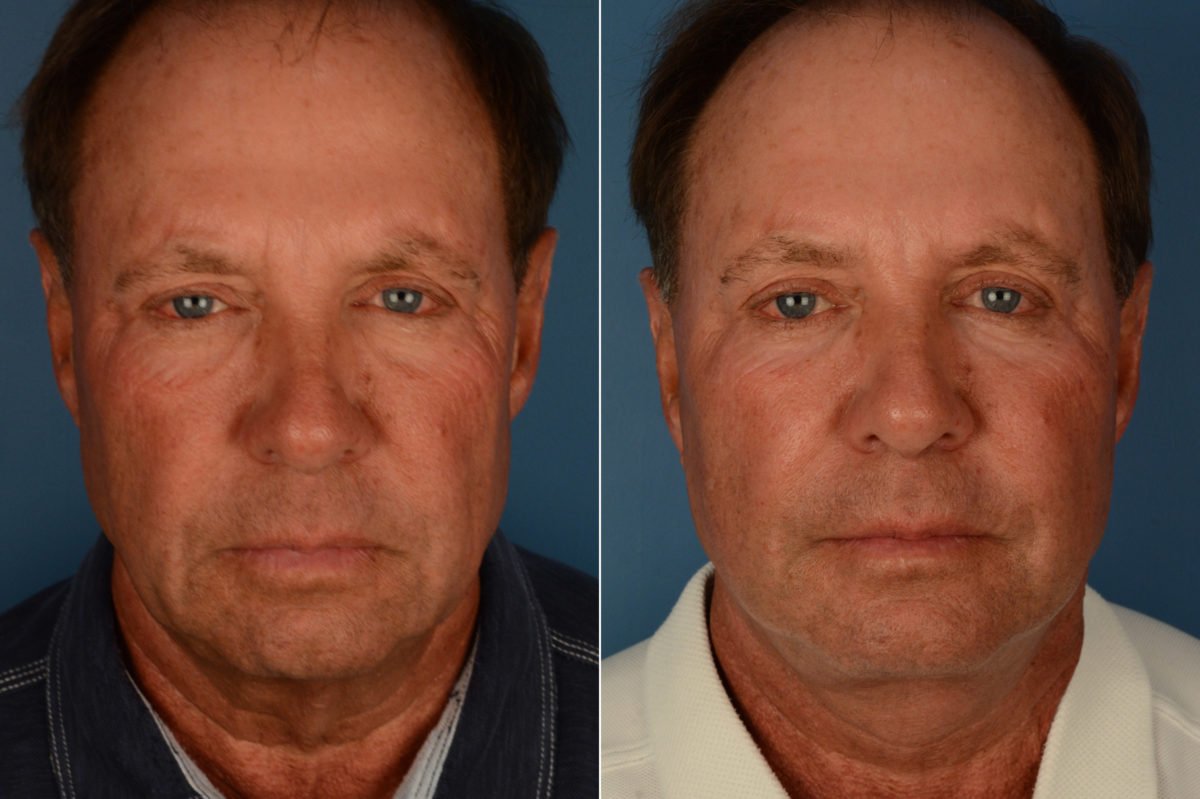The UpLift™ Lower Face and Neck Lift Before and After Photos in Naples, FL, Patient 19335