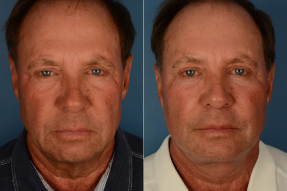 The UpLift™ Lower Face and Neck Lift Before and After Photos in Naples, FL, Patient 19335