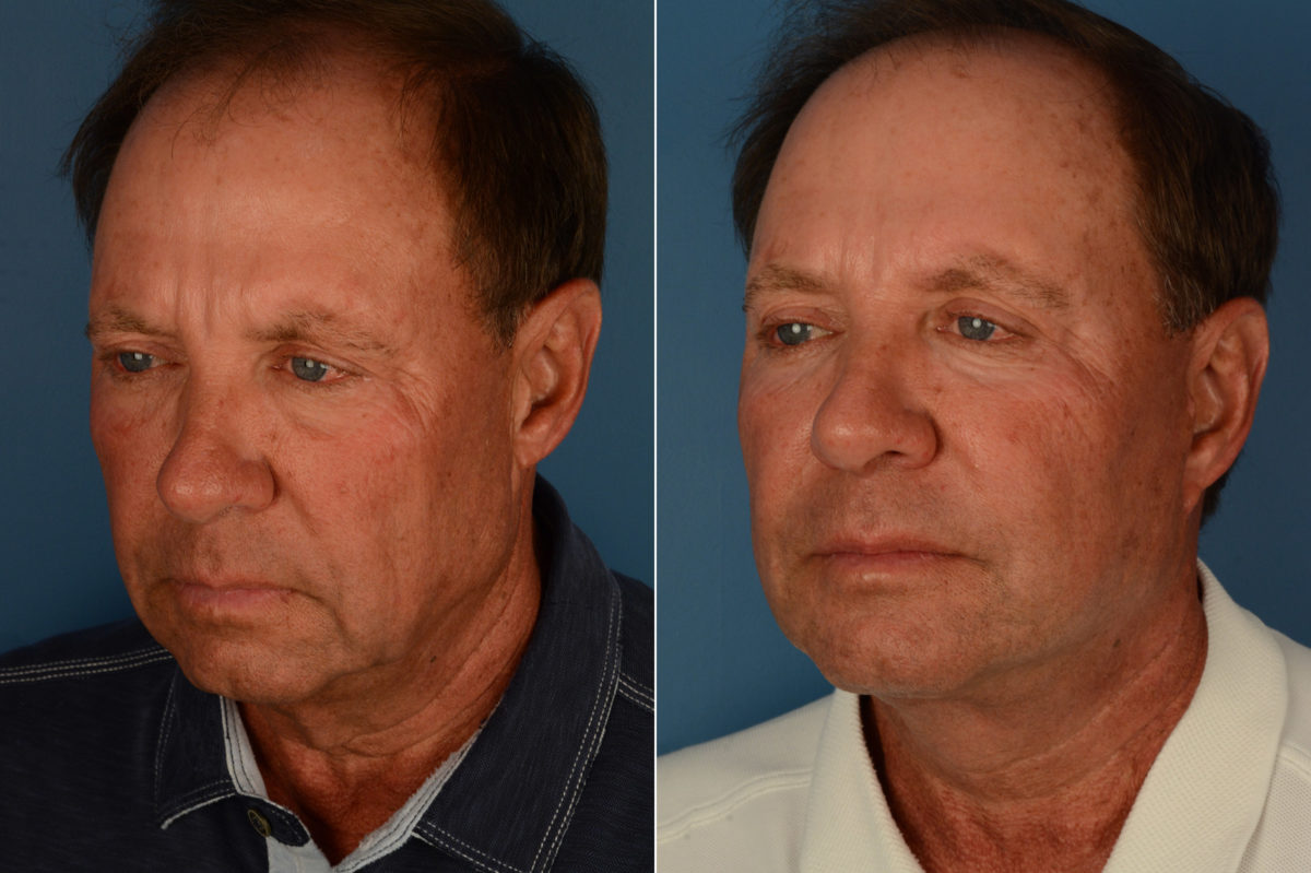 The UpLift™ Lower Face and Neck Lift Before and After Photos in Naples, FL, Patient 19335