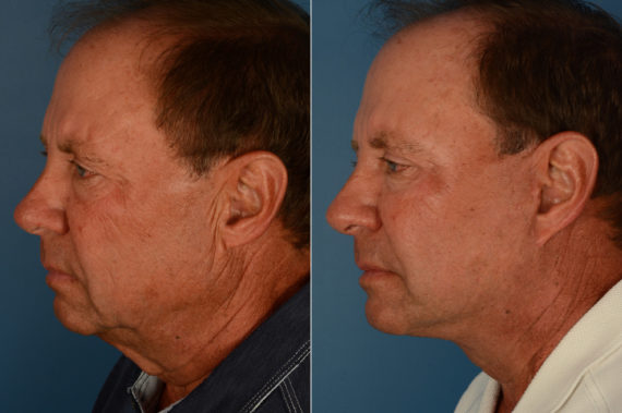 The UpLift™ Lower Face and Neck Lift Before and After Photos in Naples, FL, Patient 19335