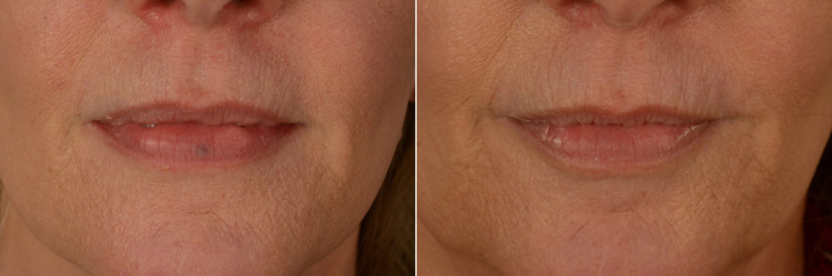 Cutera Excel V Laser Before and After Photos in Naples, FL, Patient 19386